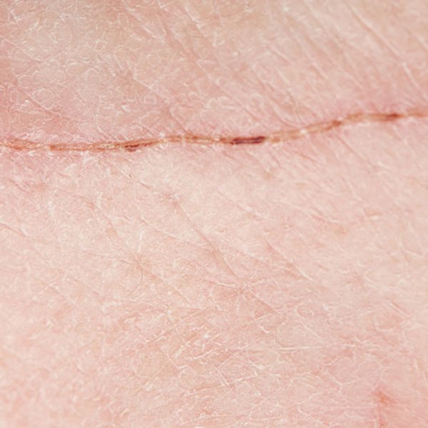 https://africa.laroche-posay.com/-/media/project/loreal/brand-sites/lrp/emea/za/articles/damaged-skin/damaged-articles/larocheposay-articlepage-damaged-how-to-optimise-scar-healing.jpg?cx=0.5&cy=0.91&cw=600&ch=600&hash=8E417113AD55435FFF899A21F12C7C7CB4CFDD0A
