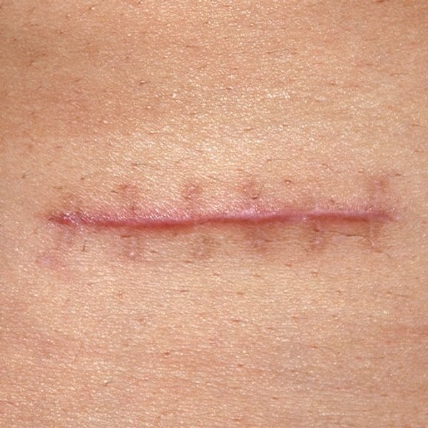 Stitches Scar Stitches Scar
