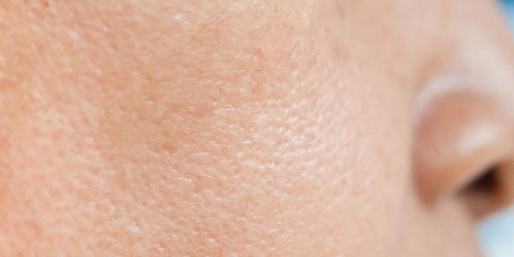 Larocheposay SubCategoryPage Acne What causes oily acne prone skin how